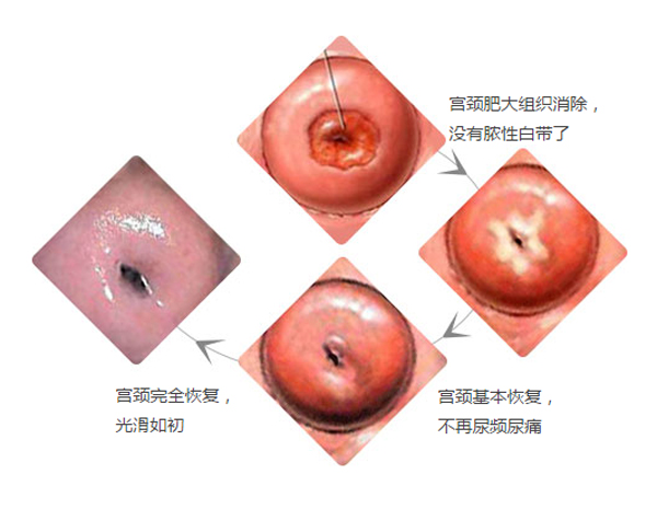 宫颈肥大发病症状?